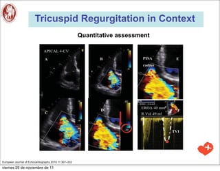 Tricuspid Regurgitation in Context
                                                       Quantitative assessment




European Journal of Echocardiography 2010;11:307–332

viernes 25 de noviembre de 11
 