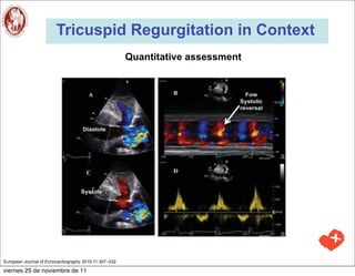 Tricuspid Regurgitation in Context
                                                       Quantitative assessment




European Journal of Echocardiography 2010;11:307–332

viernes 25 de noviembre de 11
 