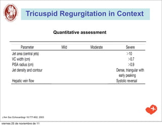 Tricuspid Regurgitation in Context

                                         Quantitative assessment




J Am Soc Echocardiogr 16:777-802, 2003

viernes 25 de noviembre de 11
 