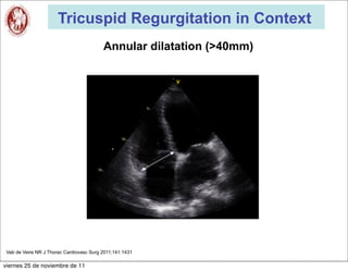 Tricuspid Regurgitation in Context
                                          Annular dilatation (>40mm)




 Vab de Veire NR J Thorac Cardiovasc Surg 2011;141:1431

viernes 25 de noviembre de 11
 