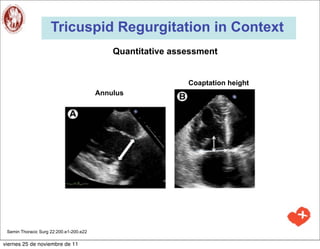 Tricuspid Regurgitation in Context
                                             Quantitative assessment


                                                             Coaptation height
                                         Annulus




                                                    4,7          2,6


 Semin Thoracic Surg 22:200.e1-200.e22

viernes 25 de noviembre de 11
 