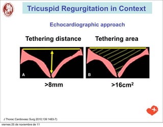 Tricuspid Regurgitation in Context

                                    Echocardiographic approach

                  Tethering distance               Tethering area




                                >8mm                     >16cm2




 J Thorac Cardiovasc Surg 2010;139:1483-7)
viernes 25 de noviembre de 11
 