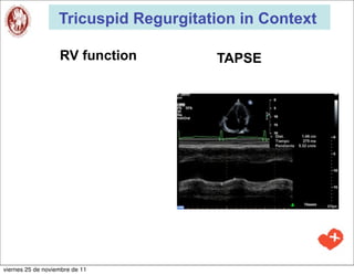 Tricuspid Regurgitation in Context

                   RV function         TAPSE




viernes 25 de noviembre de 11
 