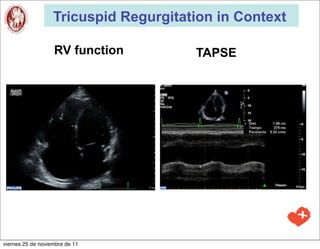 Tricuspid Regurgitation in Context

                   RV function         TAPSE




viernes 25 de noviembre de 11
 