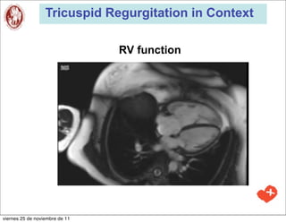 Tricuspid Regurgitation in Context

                                RV function




viernes 25 de noviembre de 11
 