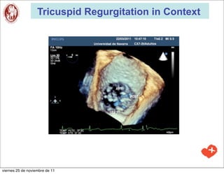 Tricuspid Regurgitation in Context




viernes 25 de noviembre de 11
 