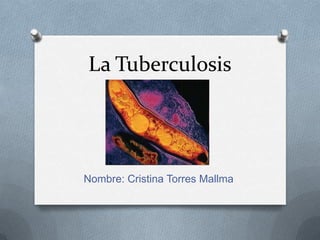 La Tuberculosis
Nombre: Cristina Torres Mallma
 