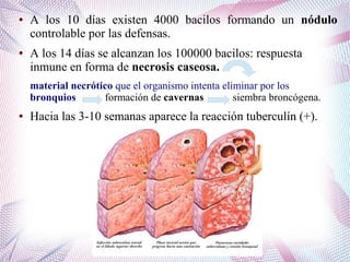 ● A los 10 días existen 4000 bacilos formando un nódulo
controlable por las defensas.
● A los 14 días se alcanzan los 100000 bacilos: respuesta
inmune en forma de necrosis caseosa.
material necrótico que el organismo intenta eliminar por los
bronquios formación de cavernas siembra broncógena.
● Hacia las 3-10 semanas aparece la reacción tuberculín (+).
 