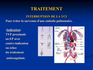 TRAITEMENTLes anti-thrombotiques orauxEtude RECOVER: *DABIGATRAN (inhibiteur direct de la thrombine)*RIVAROXABAN(inhibiteur direct du facteur Xa)versus WARFARINE (coumadine)Conclusion:-traitement curatif (ACFA-valves-MTE) ou prophylactique.-Même efficacité-Moins de saignement-Pas de surveillance bio.-pas d’interaction avec les alimentsRévolution dans la thérapeutique