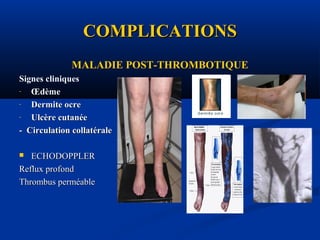 COMPLICATIONSCOMPLICATIONS
MALADIE POST-THROMBOTIQUE
Signes cliniques
- Œdème
- Dermite ocreDermite ocre
- Ulcère cutanéeUlcère cutanée
- Circulation collatérale- Circulation collatérale
 ECHODOPPLERECHODOPPLER
Reflux profondReflux profond
Thrombus perméableThrombus perméable
 