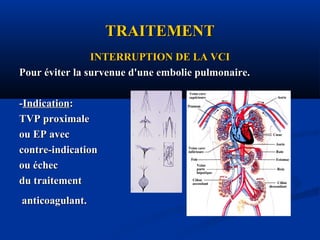 TRAITEMENTTRAITEMENT
INTERRUPTION DE LA VCIINTERRUPTION DE LA VCI
Pour éviter la survenue d'une embolie pulmonaire.Pour éviter la survenue d'une embolie pulmonaire.
--IndicationIndication::
TVP proximaleTVP proximale
ou EP avecou EP avec
contre-indicationcontre-indication
ou échecou échec
du traitementdu traitement
anticoagulant.anticoagulant.
 