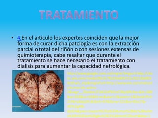 • 4.En el articulo los expertos coinciden que la mejor
  forma de curar dicha patología es con la extracción
  parcial o total del riñón o con sesiones extensas de
  quimioterapia, cabe resaltar que durante el
  tratamiento se hace necesario el tratamiento con
  dialisis para aumentar la capacidad nefrológica.
                       http://www.google.com.co/imgres?imgurl=http://sta
                       tic.wix.com/media/85cfc7fb235e806721c92218a803
                       dcbf.wix_mp&imgrefurl=http://www.wix.com/nelcyd
                       s/tumor-de-wilms-
                       2&usg=__Z6oi6w1F3d1OtPN5mT00yi6Rr3w=&h=288
                       &w=358&sz=44&hl=es&start=3&zoom=1&tbnid=Pv5
                       2cFBnc8dqLM:&tbnh=97&tbnw=121&ei=05o1Tp-
                       dDYz2gAfb-
                       djnDA&prev=/search%3Fq%3Dtumor%2Bde%2Bwilm
                       s%26hl%3Des%26gbv%3D2%26tbm%3Disch&itbs=1
 
