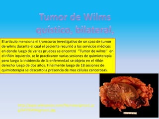 El articulo menciona el transcurso investigativo de un caso de tumor
de wilms durante el cual el paciente recurrió a los servicios médicos
en donde luego de varias pruebas se encontró ‘’Tumor de wilms’’ en
el riñón izquierdo, se le practicaron varias sesiones de quimioterapia
pero luego la incidencia de la enfermedad se objeto en el riñón
derecho luego de dos años. Finalmente luego de 18 sesiones de
quimioterapia se descarto la presencia de mas células cancerosas.




          http://pqax.wikispaces.com/file/view/gross1.jp
          g/64793494/gross1.jpg
 