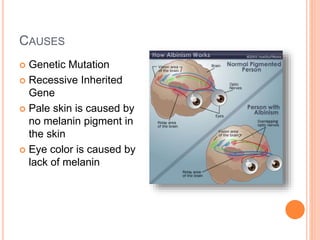 CAUSES
 Genetic Mutation
 Recessive Inherited
Gene
 Pale skin is caused by
no melanin pigment in
the skin
 Eye color is caused by
lack of melanin
 