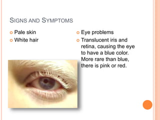 SIGNS AND SYMPTOMS
 Pale skin
 White hair
 Eye problems
 Translucent iris and
retina, causing the eye
to have a blue color.
More rare than blue,
there is pink or red.
 