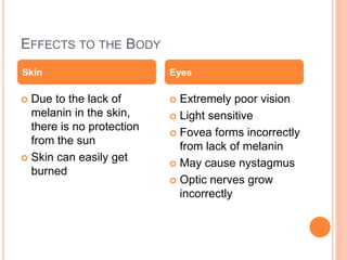 EFFECTS TO THE BODY
 Due to the lack of
melanin in the skin,
there is no protection
from the sun
 Skin can easily get
burned
 Extremely poor vision
 Light sensitive
 Fovea forms incorrectly
from lack of melanin
 May cause nystagmus
 Optic nerves grow
incorrectly
Skin Eyes
 