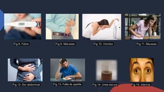 Fig.8- Febre Fig.9- Mal-estar Fig.11- Náuseas
Fig.10- Vómitos
Fig.12- Dor abdominal Fig.13- Falta de apetite Fig.14- Ureia escura Fig.15- Icterícia
 