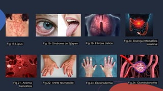 Fig.17-Lúpus Fig.19- Fibrose cística
Fig.21- Anemia
hemolítica
Fig.18- Síndrome de Sjögren
Fig.20- Doença inflamatória
intestinal
Fig.22- Artrite reumatoide Fig.23- Esclerodermia Fig.24- Glomerulonefrite
 
