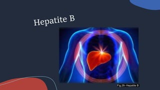 Fig.26- Hepatite B
 