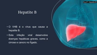 • O VHB é o vírus que causa a
hepatite B.
• Esta infeção viral desenvolve
doenças hepáticas graves, como a
cirrose e cancro no fígado.
Hepatite B
Fig.27- Hepatite B
 