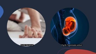 Fig.28- Via sexual Fig.29- Transmissão vertical
 