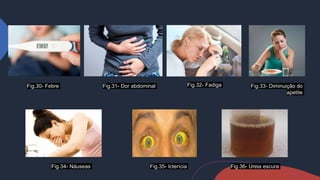 Fig.30- Febre
Fig.34- Náuseas
Fig.32- Fadiga
Fig.31- Dor abdominal Fig.33- Diminuição do
apetite
Fig.36- Ureia escura
Fig.35- Icterícia
 