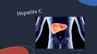 Fig.44- Hepatite C
 