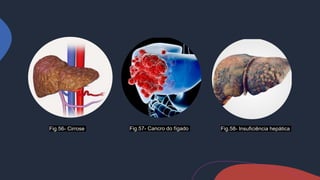 Fig.56- Cirrose Fig.57- Cancro do fígado Fig.58- Insuficiência hepática
 