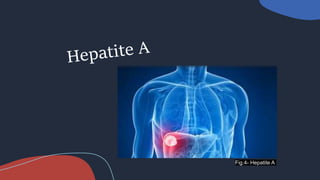 Fig.4- Hepatite A
 