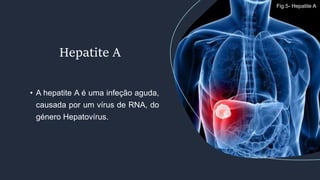 • A hepatite A é uma infeção aguda,
causada por um vírus de RNA, do
género Hepatovírus.
Hepatite A
Fig.5- Hepatite A
 