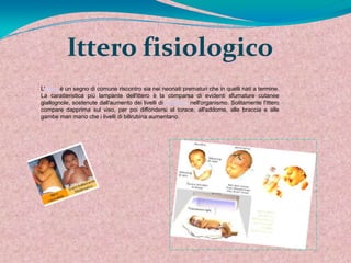 Ittero fisiologico
L'ittero è un segno di comune riscontro sia nei neonati prematuri che in quelli nati a termine.
La caratteristica più lampante dell'ittero è la comparsa di evidenti sfumature cutanee
giallognole, sostenute dall'aumento dei livelli di bilirubina nell'organismo. Solitamente l'ittero
compare dapprima sul viso, per poi diffondersi al torace, all'addome, alle braccia e alle
gambe man mano che i livelli di bilirubina aumentano.
 