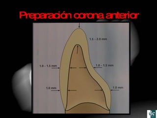 Preparación corona anterior 