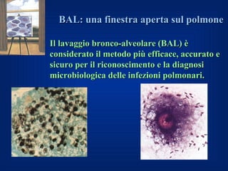 BAL: una finestra aperta sul polmone

Il lavaggio bronco-alveolare (BAL) è
considerato il metodo più efficace, accurato e
sicuro per il riconoscimento e la diagnosi
microbiologica delle infezioni polmonari.
 