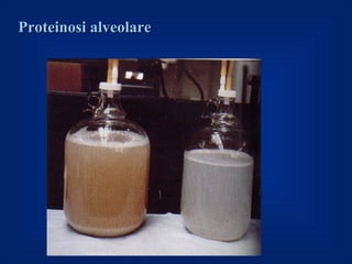 Proteinosi alveolare
 
