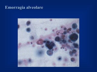 Emorragia alveolare
 