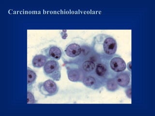 Carcinoma bronchioloalveolare
 
