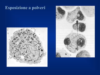 Esposizione a polveri
 