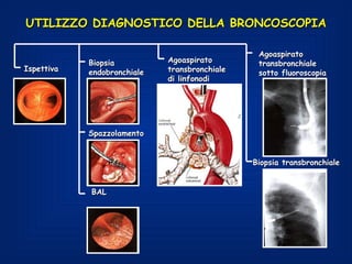 UTILIZZO DIAGNOSTICO DELLA BRONCOSCOPIA

                                                Agoaspirato
            Biopsia          Agoaspirato        transbronchiale
Ispettiva   endobronchiale   transbronchiale    sotto fluoroscopia
                             di linfonodi




            Spazzolamento


                                               Biopsia transbronchiale


            BAL
 