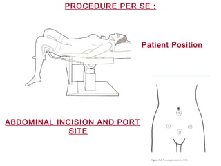PROCEDURE PER SE :
ABDOMINAL INCISION AND PORT
SITE
Patient Position
 