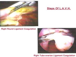 Right Round Ligament Coagulation
Right Tubo-ovarian Ligament Coagulation
Steps Of L.A.V.H.
 