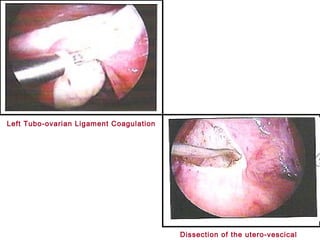 Left Tubo-ovarian Ligament Coagulation
Dissection of the utero-vescical
 