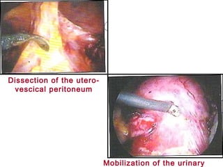 Mobilization of the urinary
Dissection of the utero-
vescical peritoneum
 