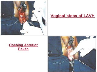Vaginal steps of LAVH
Opening Anterior
Pouch
 