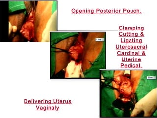 Opening Posterior Pouch.
Delivering Uterus
Vaginaly
Clamping
Cutting &
Ligating
Uterosacral
Cardinal &
Uterine
Pedical.
 