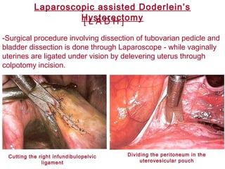 -Surgical procedure involving dissection of tubovarian pedicle and
bladder dissection is done through Laparoscope - while vaginally
uterines are ligated under vision by delevering uterus through
colpotomy incision.
[ L A D H ]
Laparoscopic assisted Doderlein’s
Hysterectomy
Cutting the right infundibulopelvic
ligament
Dividing the peritoneum in the
uterovesicular pouch
 