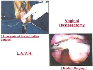 [ True state of the art Indian
Legacy]
[ Modern Surgery ]
Vaginal
Hysterectomy
L.A.V.H.
 