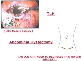 TLH
[ Ultra Modern Surgery ]
Abdominal Hystectomy
[ AN OLD ART- NEED TO DECREASE THIS MORBID
SURGERY ]
 