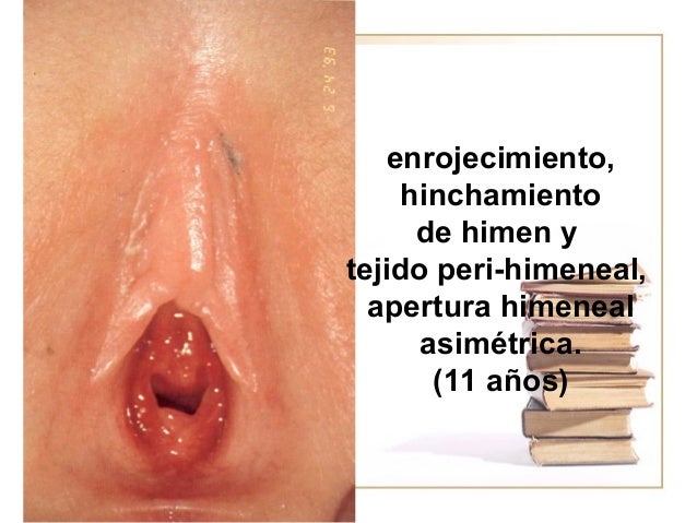 himen apertura himen apertura