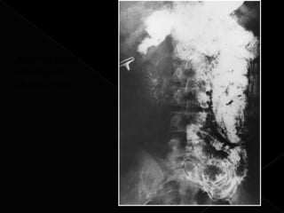 Ascaris causing
intestinal
obstruction.
 