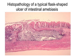 Histopathology of a typical flask-shaped
     ulcer of intestinal amebiasis
 